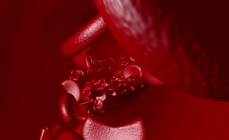 Sickle cell gene therapy that few patients can reach