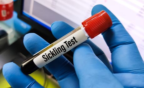 What age reveals about sickle cell disease
