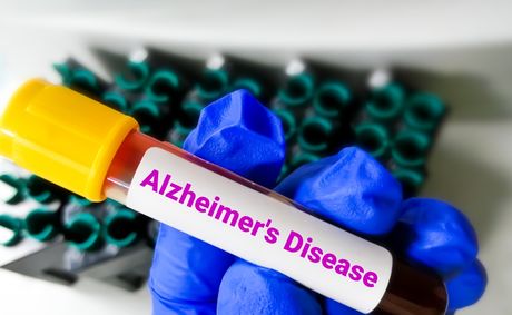 7 Alzheimer’s blood test and diagnosis facts new in 2026