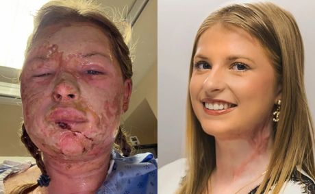 18-Year-Old Survives Fraternity Fire, Becomes First in the World to Heal Her Face Without Skin Grafts