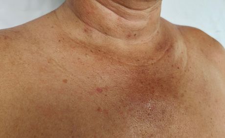 Age spots are more common than you think — Here’s what to do