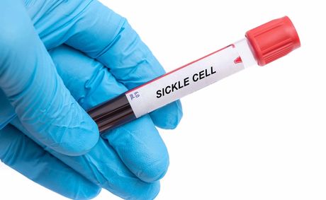 How to prevent a painful sickle cell crisis