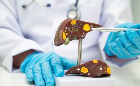 How to naturally reduce fat from your liver fast
