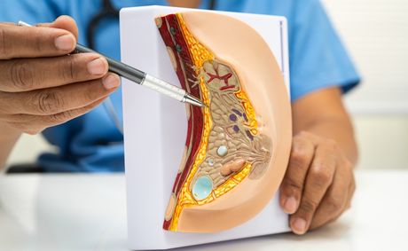 High-risk node-negative breast cancer may hide deadly risk